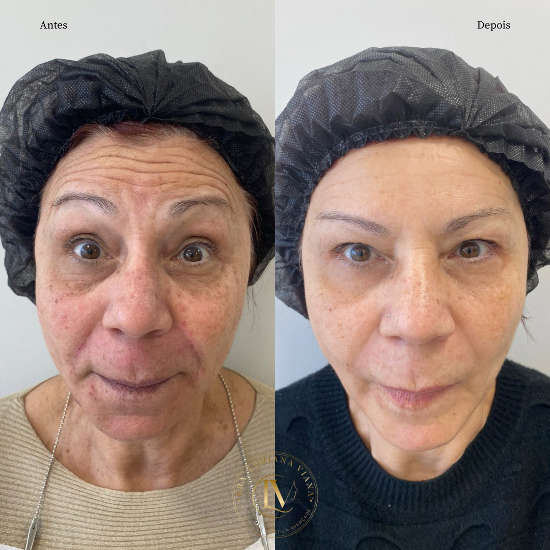 harmonizacao-facial-em-sao-paulo-2