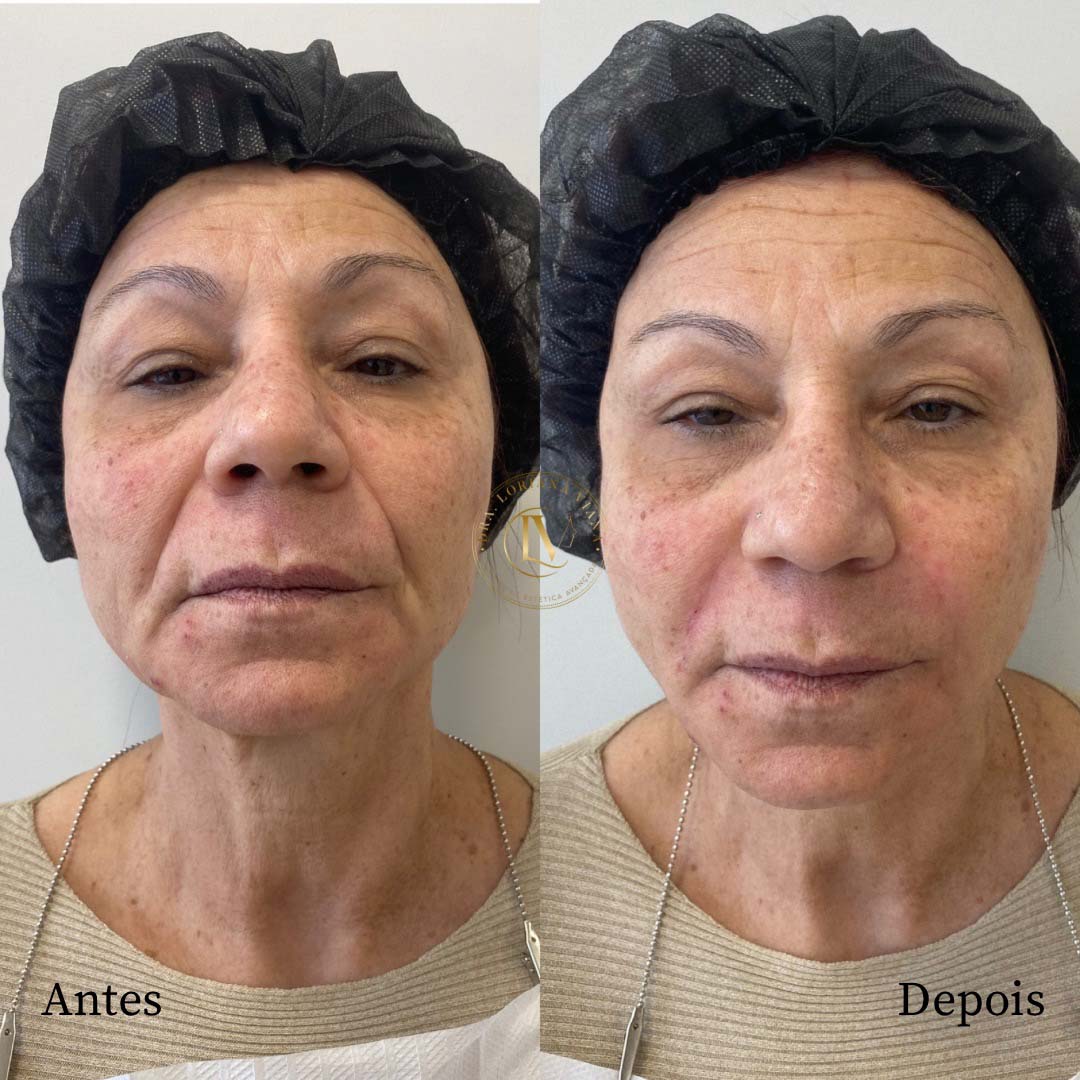 preenchimento-de-bigode-chines-em-sao-paulo-1