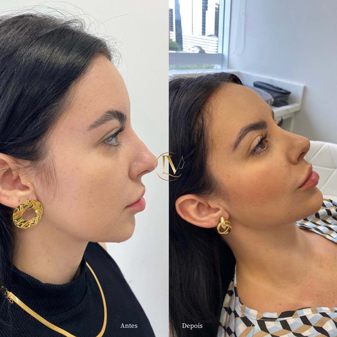 preenchimento-de-mandibula-em-sao-paulo-1