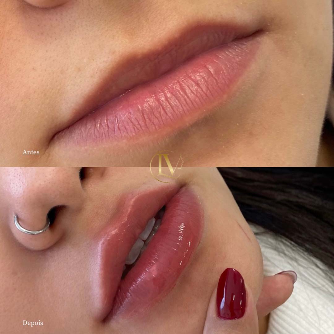 preenchimento-labial-em-sao-paulo-1