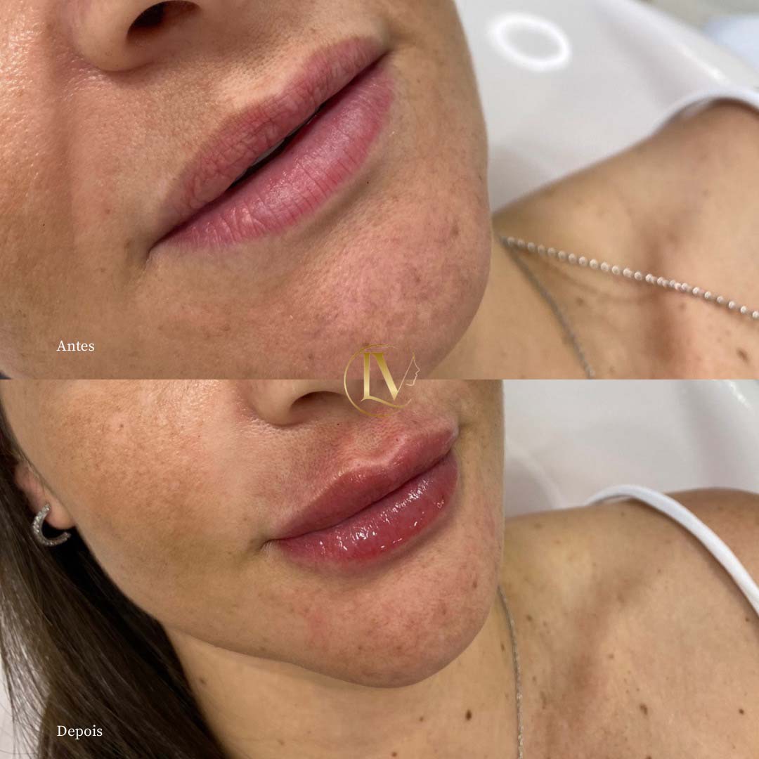 preenchimento-labial-em-sao-paulo-2