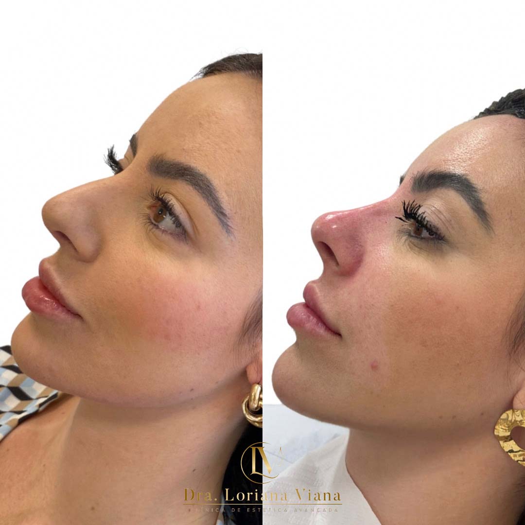 rinomodelacao-em-sao-paulo-1