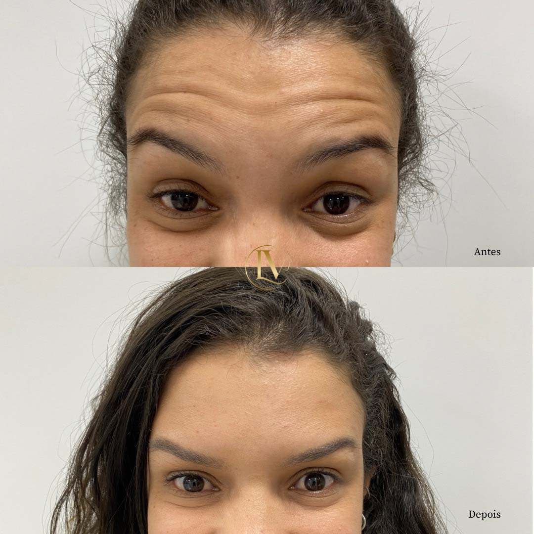 toxina-botulica-em-sao-paulo-2