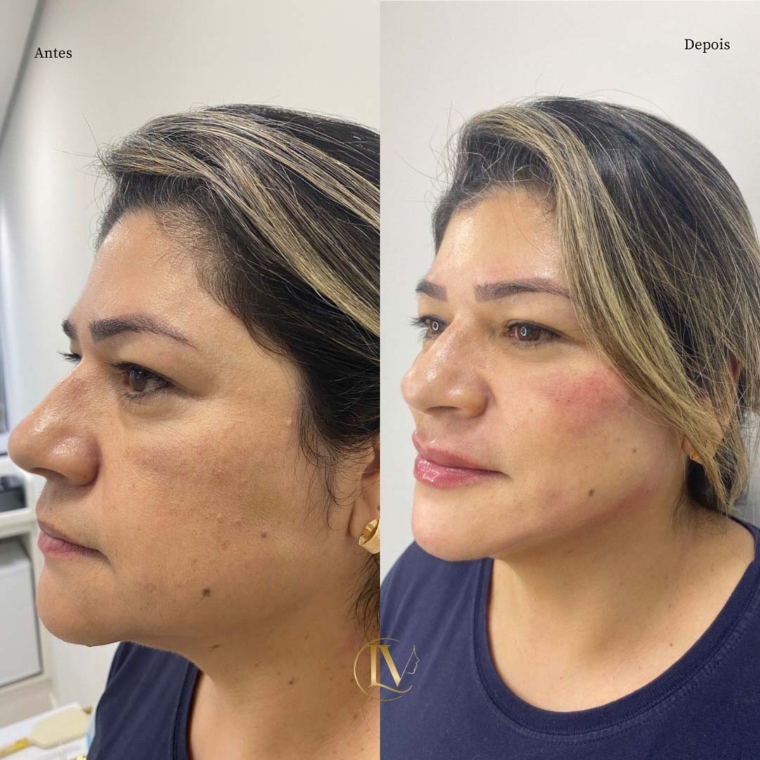 toxina-botulica-em-sao-paulo-3