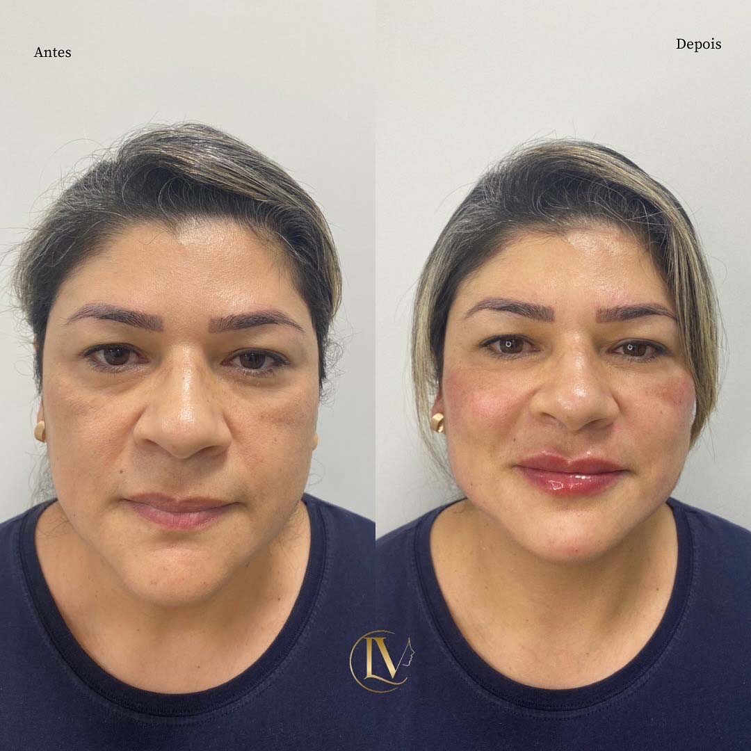 toxina-botulica-em-sao-paulo-4