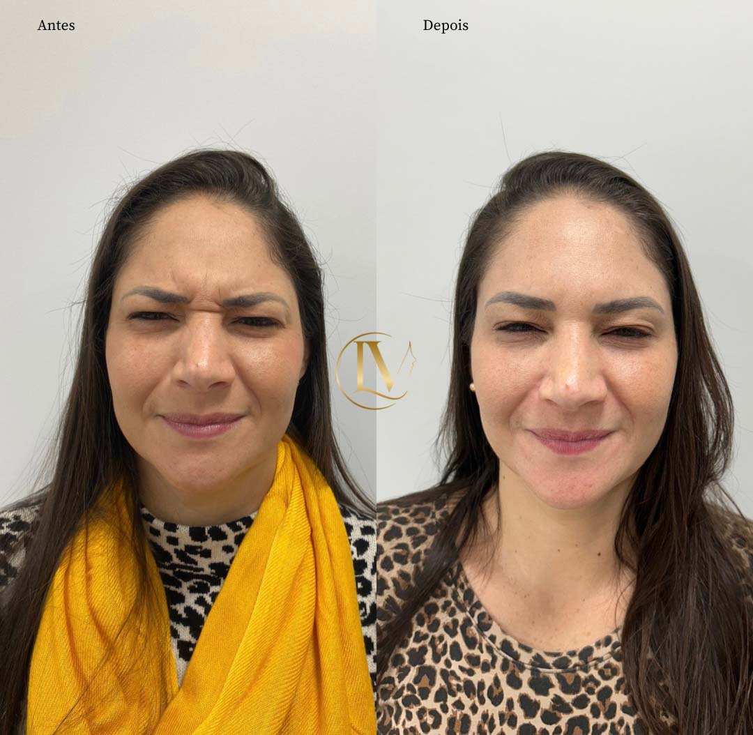 toxina-botulica-em-sao-paulo-5