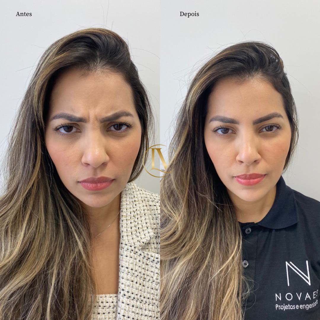 toxina-botulica-em-sao-paulo-6