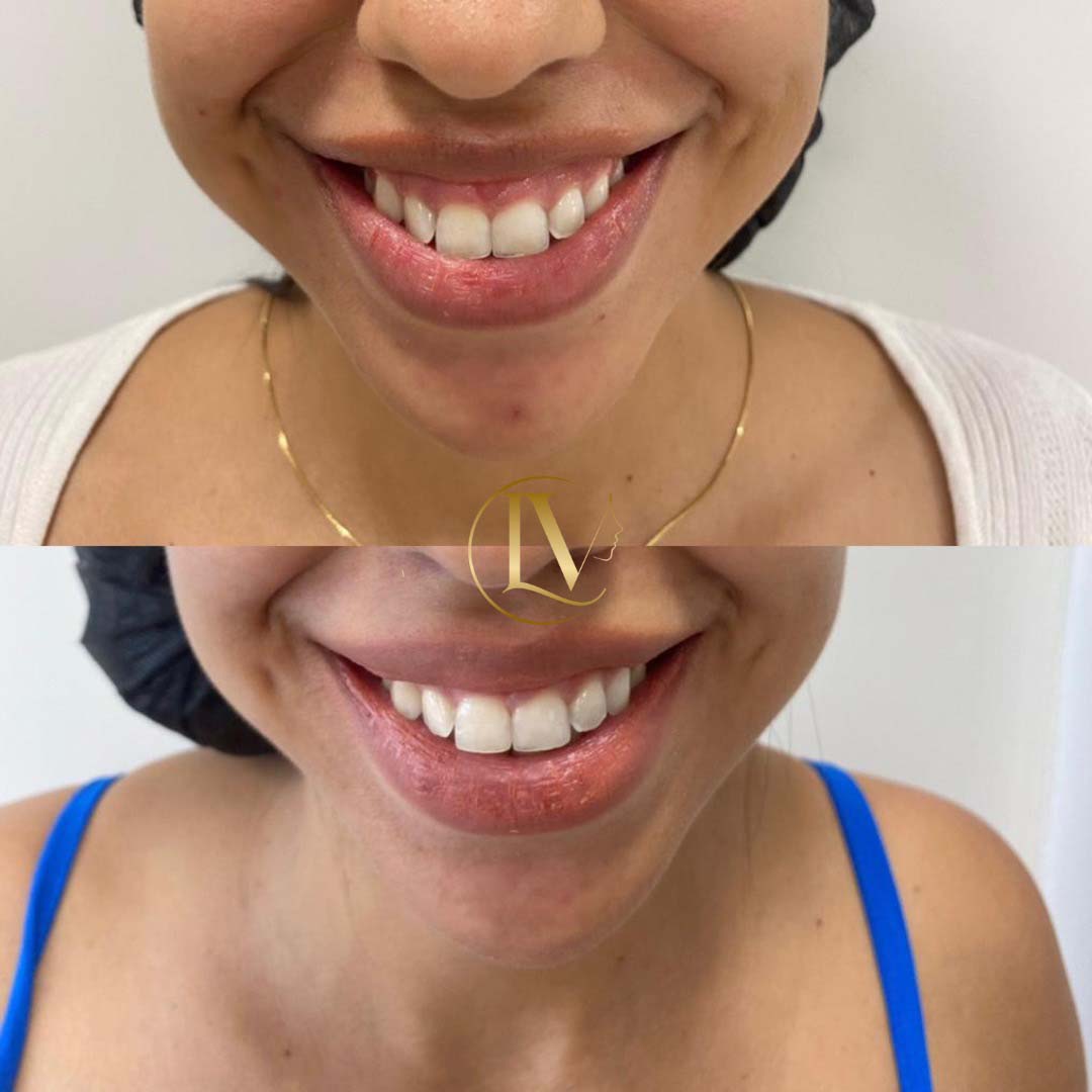 toxina-botulica-em-sao-paulo-7